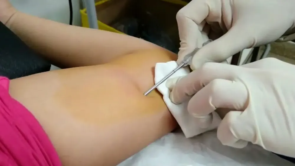 anticonceptivos subdérmicos